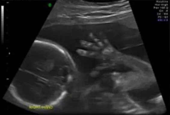 Safety Ultrasound During Pregnancy - USC