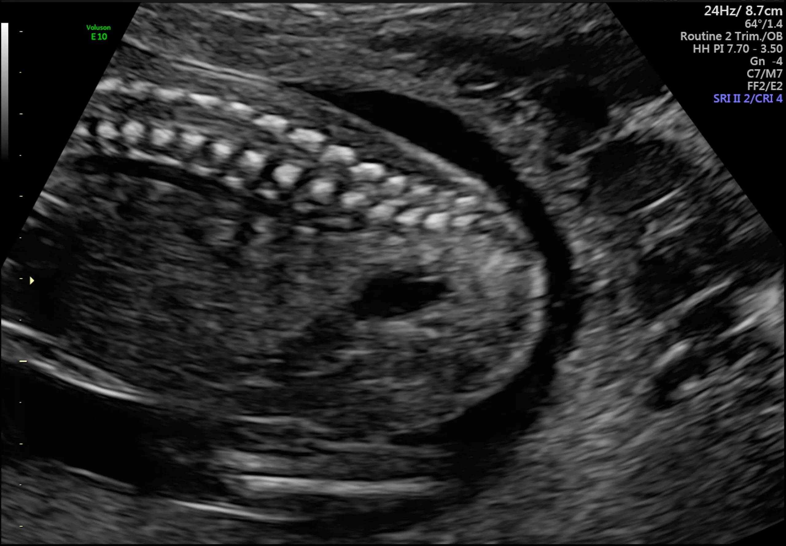 Safety Ultrasound During Pregnancy - USC