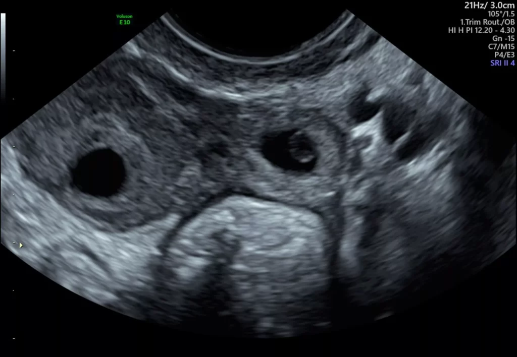 Ultrasound For Ectopic Pregnancy Sydney Ultrasound Care