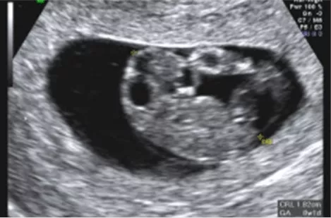 Specialist Ultrasound Clinic for Women Sydney Ultrasound Care - What can be seen on a Dating Scan?