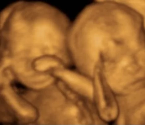 Will the scan show the baby in 3D or 4D? Ultrasound Care