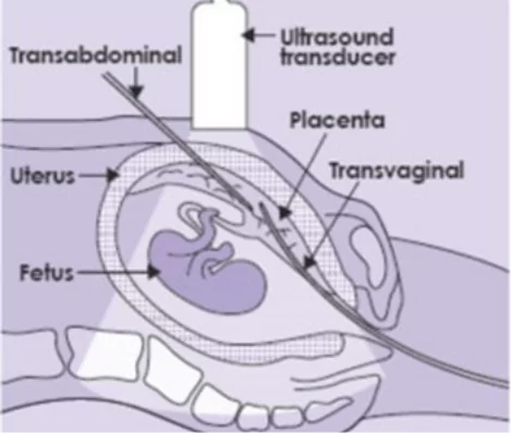Ultrasound Care - CVS Chorionic villus sampling