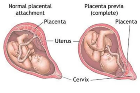 Placental Location