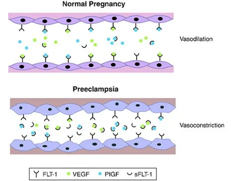 Specialist Ultrasound Clinic for Women Sydney Ultrasound Care - Pre Eclampsia Who is at risk