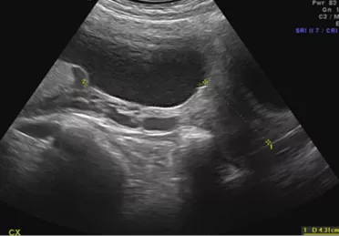 Specialist Ultrasound Clinic for Women Sydney Ultrasound Care - How low is too low for Placental Location Transabdominal