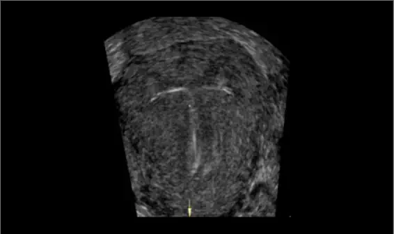 Intra Uterine Device Mirena Correct Position - Ultrasound Care