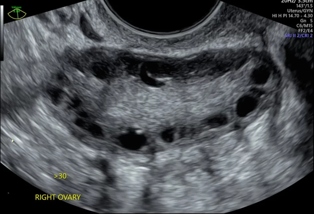 Normal Vs Polycystic Ovaries Ultrasound