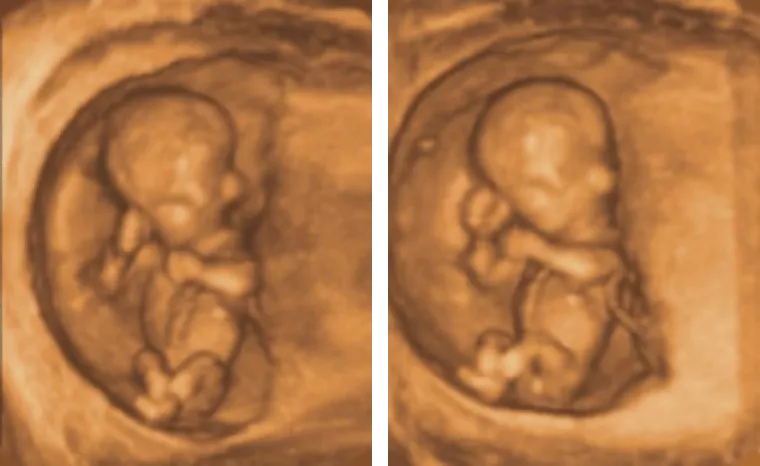 What are the benefits of 3D imaging? Ultrasound Care