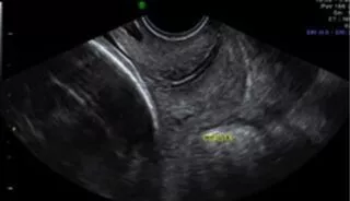 What does a fetal growth scan involve