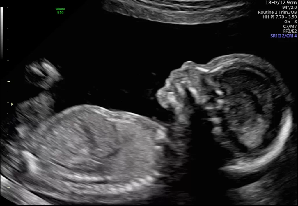 Specialist Ultrasound Clinic for Women Sydney Ultrasound Care - What happens if a problem is found during the scan