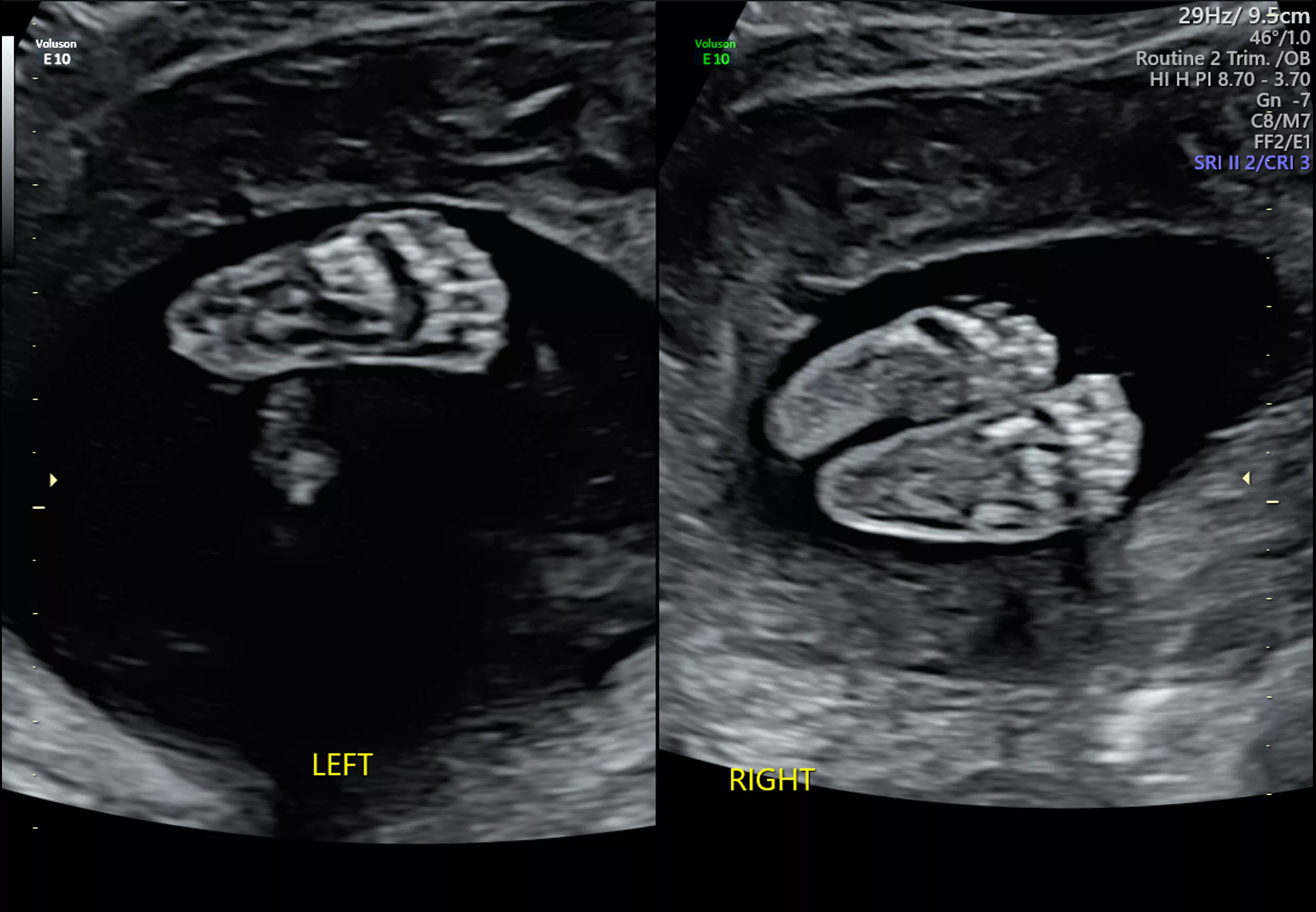 spina bifida ultrasound 12 weeks